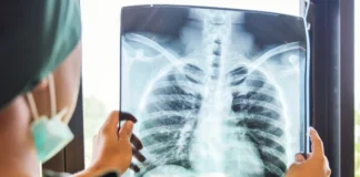 Día Mundial del Cáncer de Pulmón